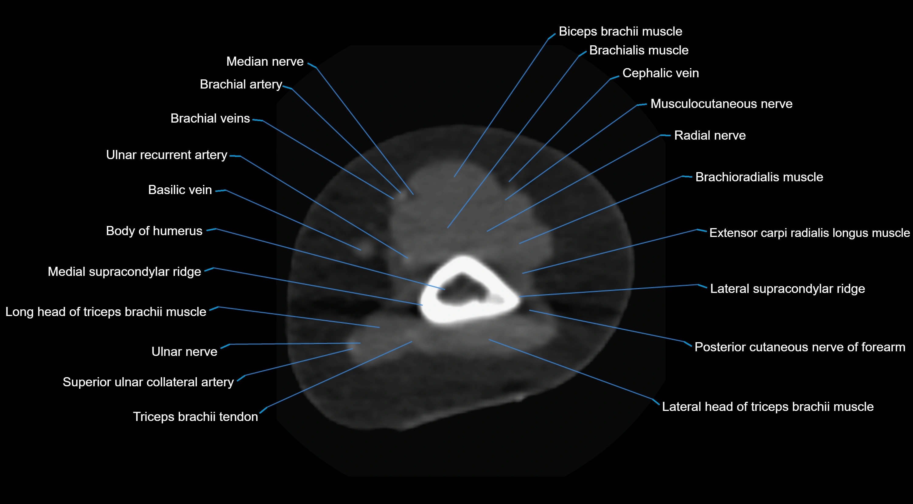 CT elbow axial  cross sectional anatomy labelled  radiology image -00001.webp